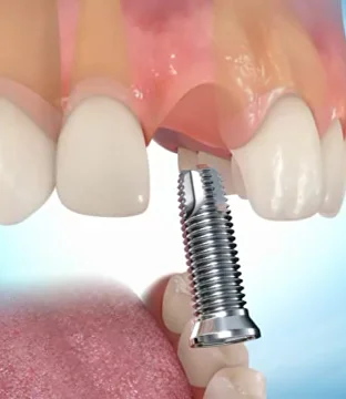 implantacia_zubov_v_